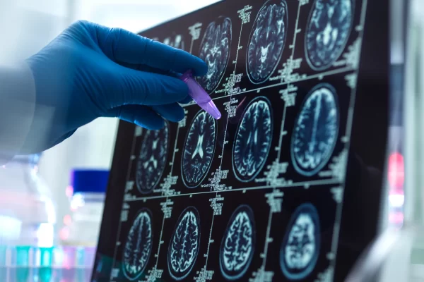 Imagen médica del cerebro que ayuda a identificar tipos de epilepsia en pacientes